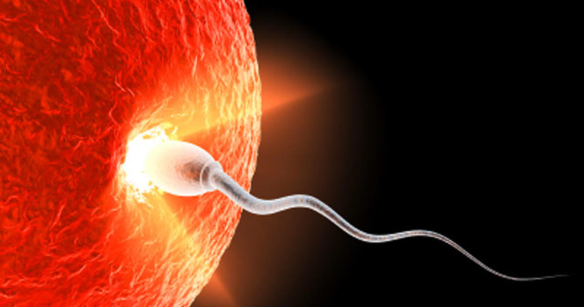Impact of reversal of vasectomy in sperm