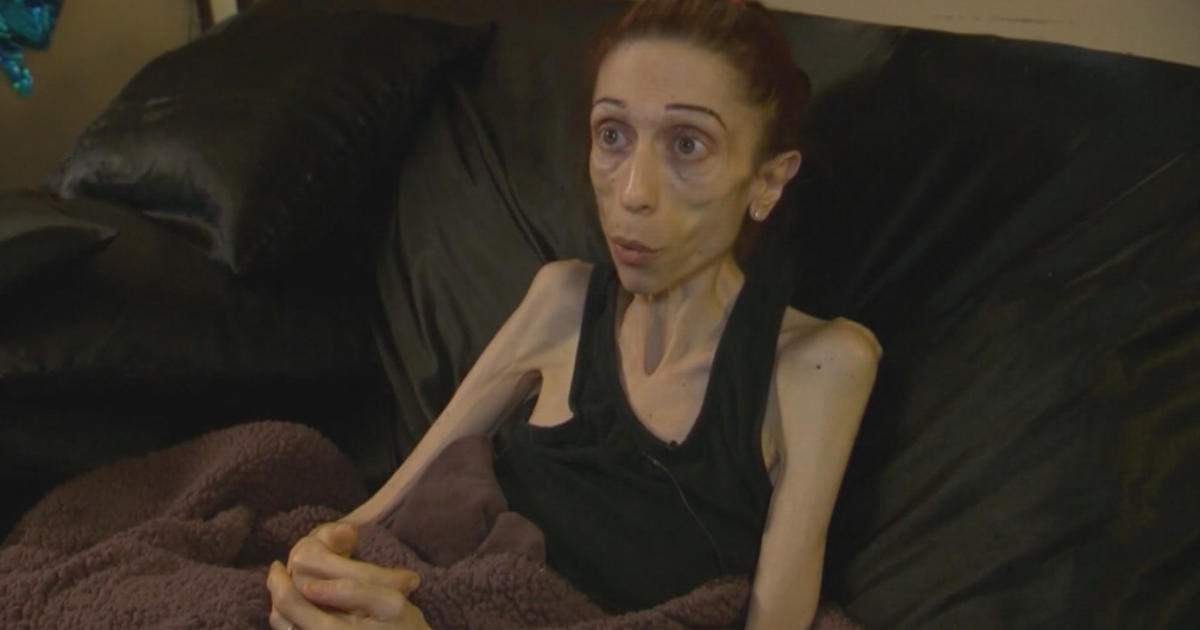 California Woman Hopes To Come To Denver For Anorexia Treatment Cbs Colorado