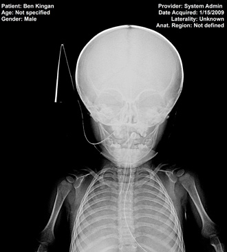 Benjamin Kingam X-ray 
