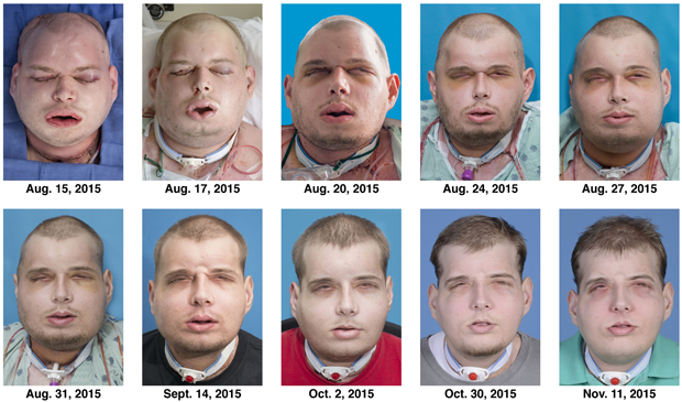 face-transplant-recovery-copy.jpg 