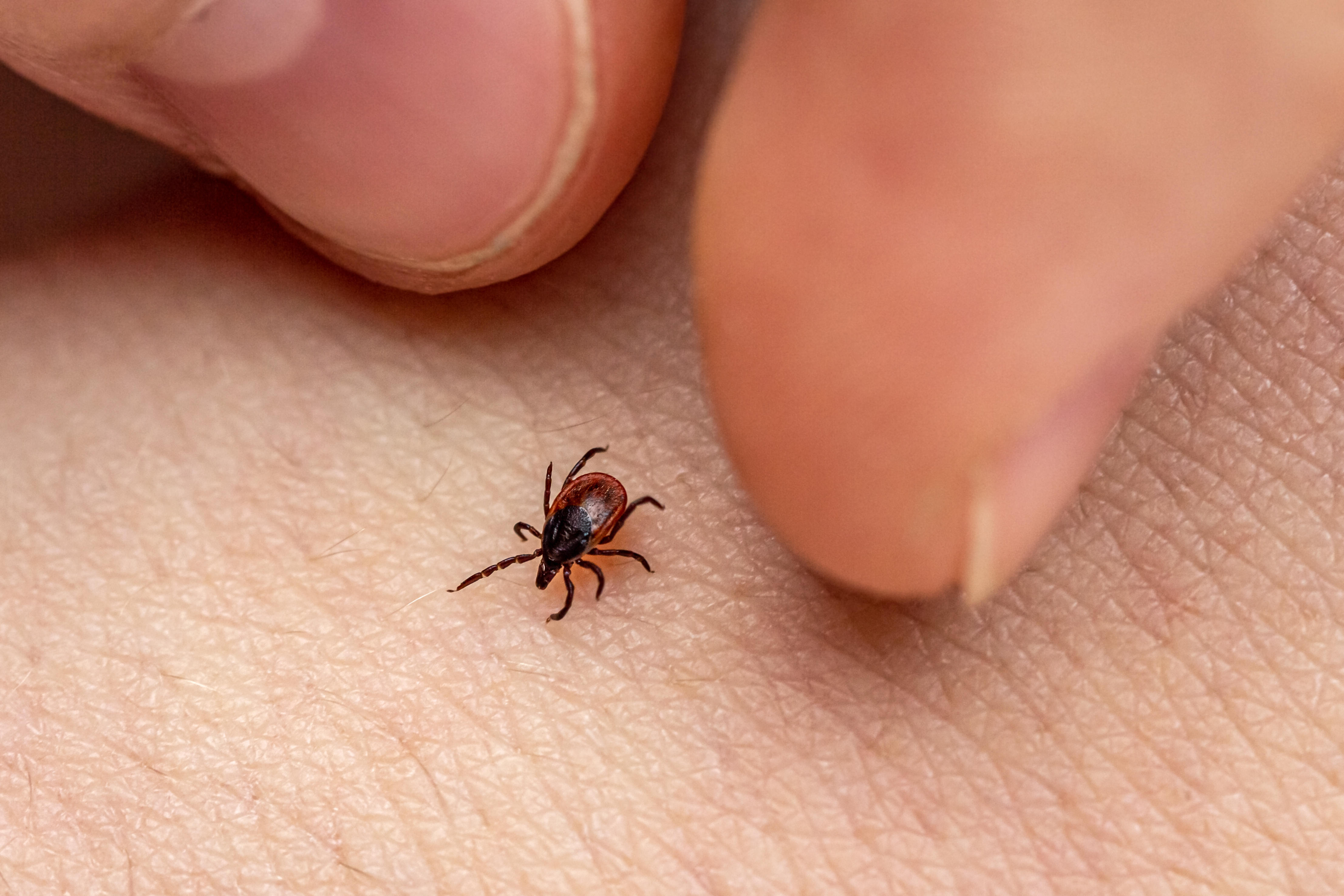 Closeup of someone delicately removing a forest tick from their body. 