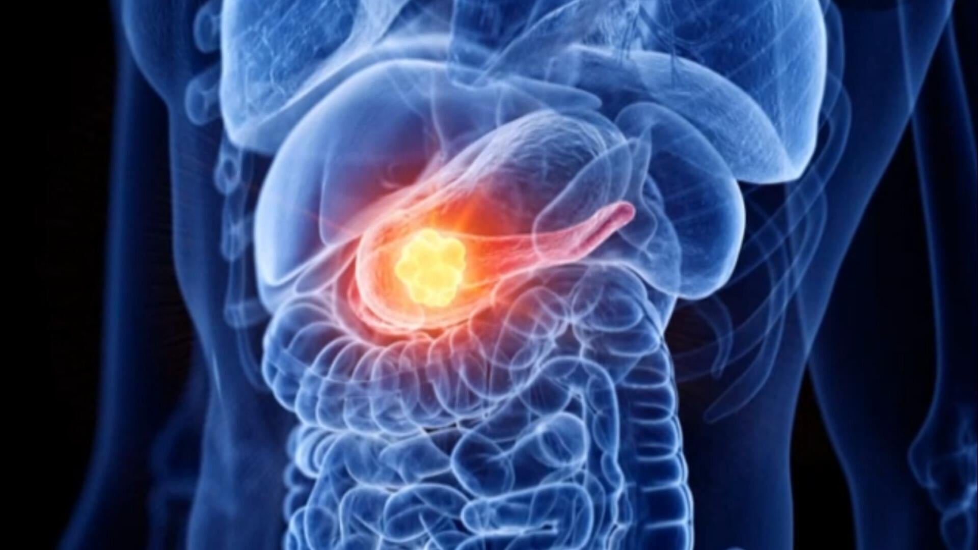 Grandfather with pancreatic cancer beats the odds with clinical trial