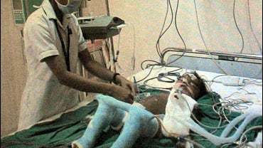 Lakshmi after the surgery 