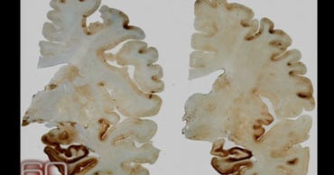 Study Links Concussions To Brain Disease - CBS News