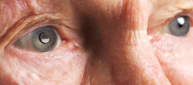 Left eye implanted with Implantable Miniature Telescope. (VisionCare) 