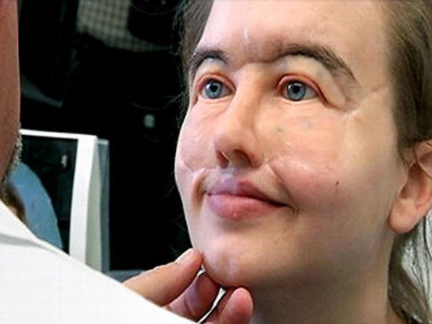 Gunshot survivor Chrissy Steltz receives incredible prosthetic face 11 years after horrific injury. 