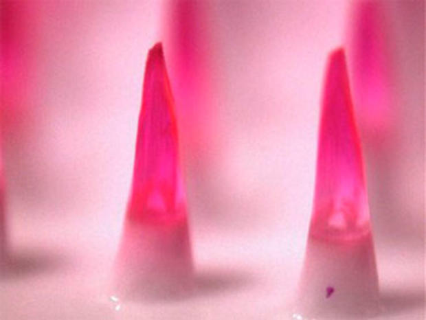 A microscopic image of dissolving microneedles, shown here encapsulating a pink dye to simulate how a vaccine would be incorporated into the needle. (AP) 