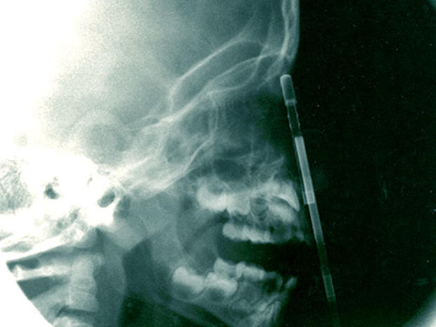 X-ray of pen shoved into head. 