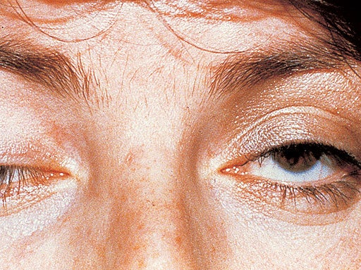 Ptosis-myasthenia-gravis.jpg