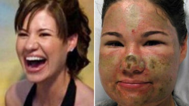 Acid Attack Hoax: Bethany Storro Pleads Not Guilty to Theft 