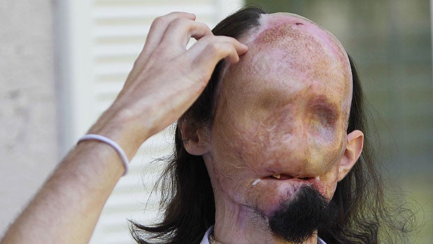 Dallas Wiens, 25, burn victim