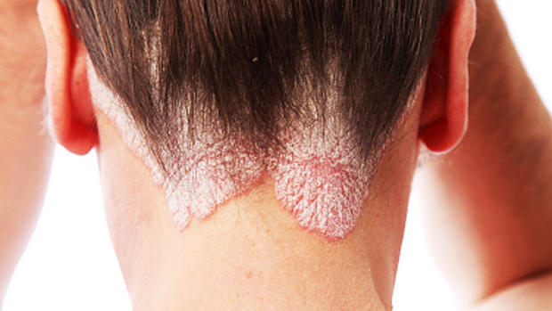 Psoriasis: 6 common myths 