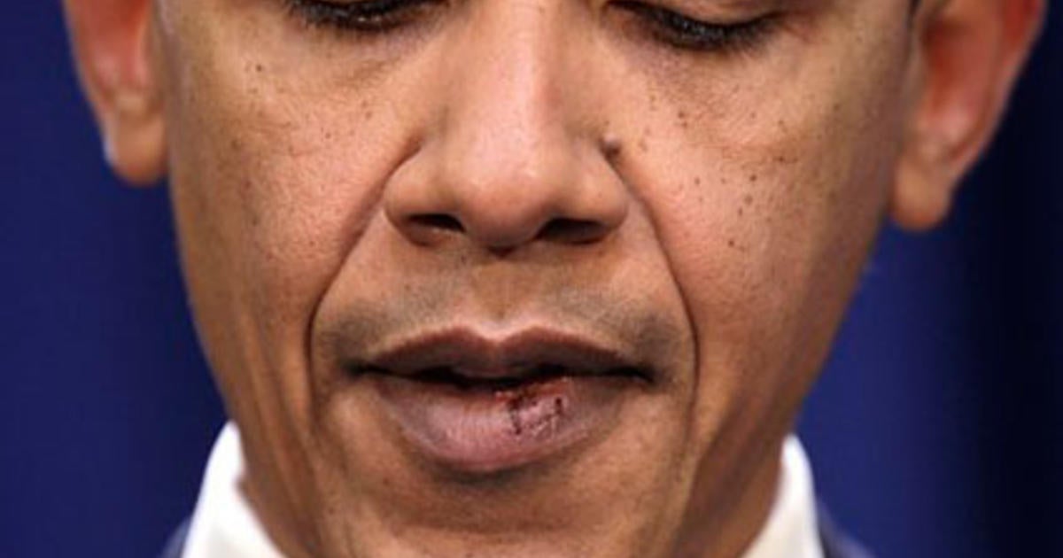 obama-gets-his-stitches-out-cbs-news