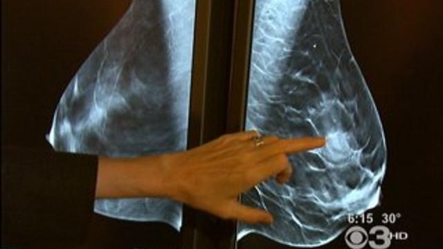 mammogram.jpg 
