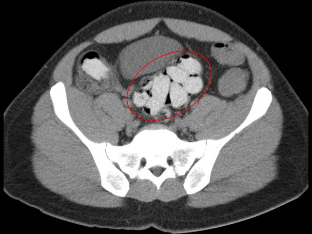 Busted! Drug mules caught on CT scans