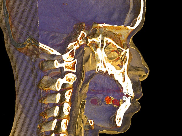 Busted! Drug mules caught on CT scans