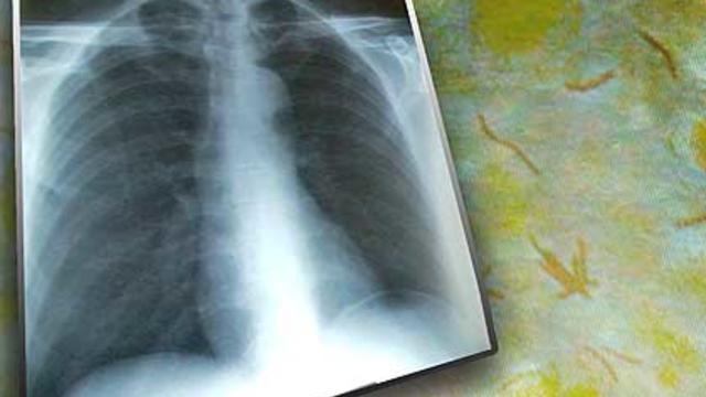 tuberculosis.jpg 