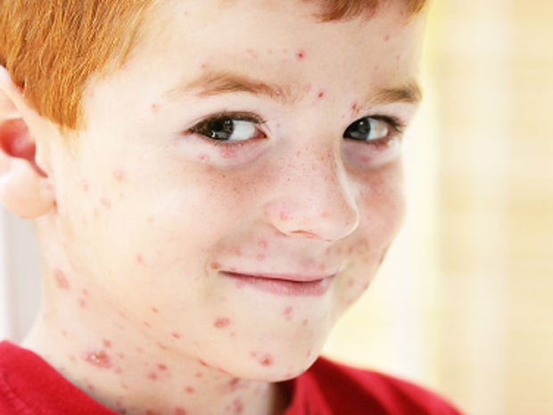 chickenpox, chicken pox, generic, 4x3