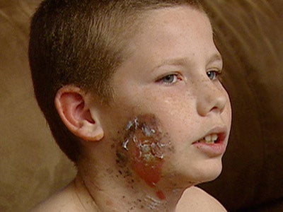 Boy doused with cologne, set on fire at sleepover 
