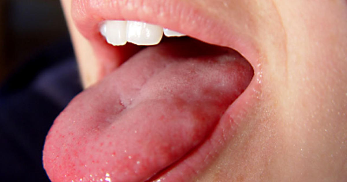 pernicious anemia tongue