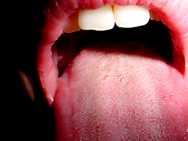 open mouth, tongue, sjogren's, stock, 4x3, mouth 
