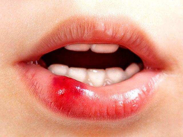 ulcer_lip_iStock_0000142734.jpg 