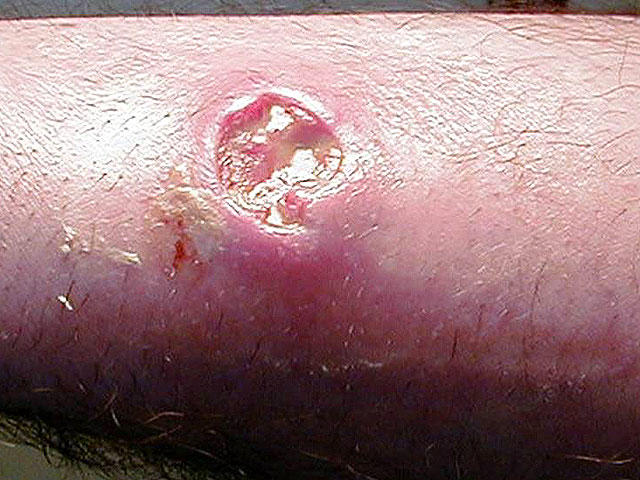 early stages staph infection on leg