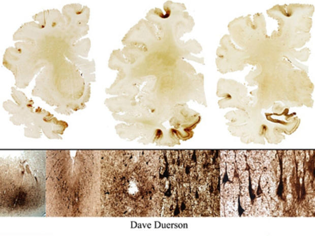 Dave Duerson Brain 