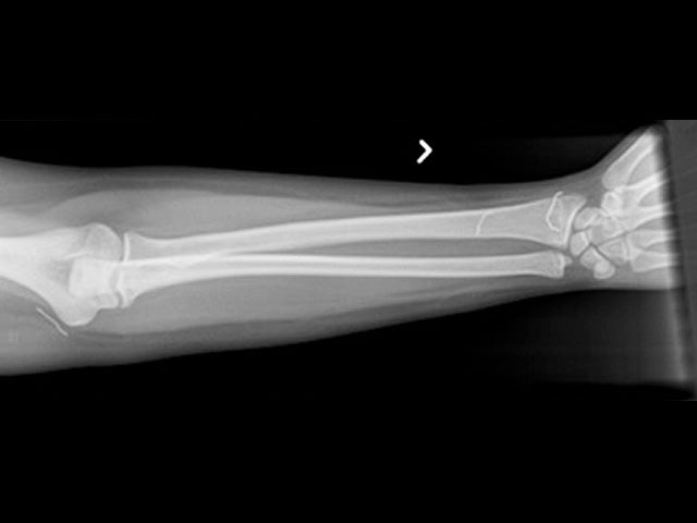 Shocking X-rays: Troubled teens' embedded objects