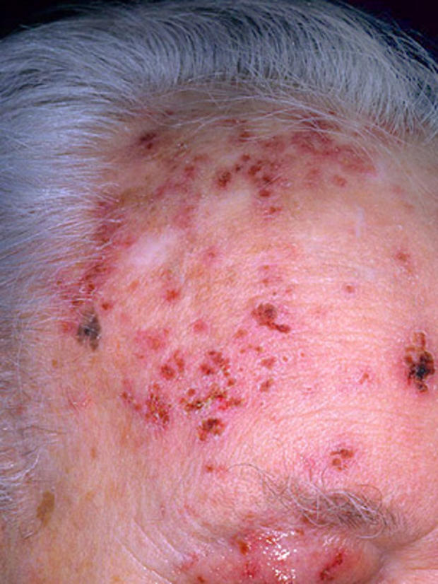 shingles, skin, rash, disease, herpes 