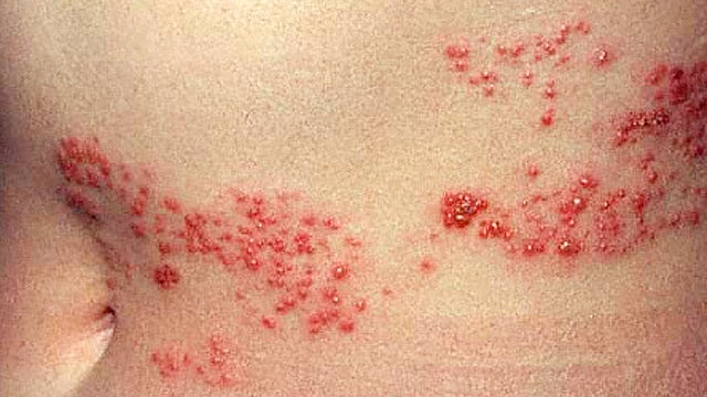 shingles01_5.jpg 