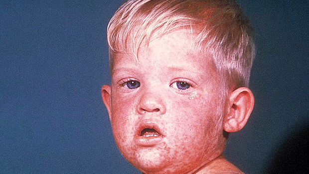 Measles: 7 things parents must know 