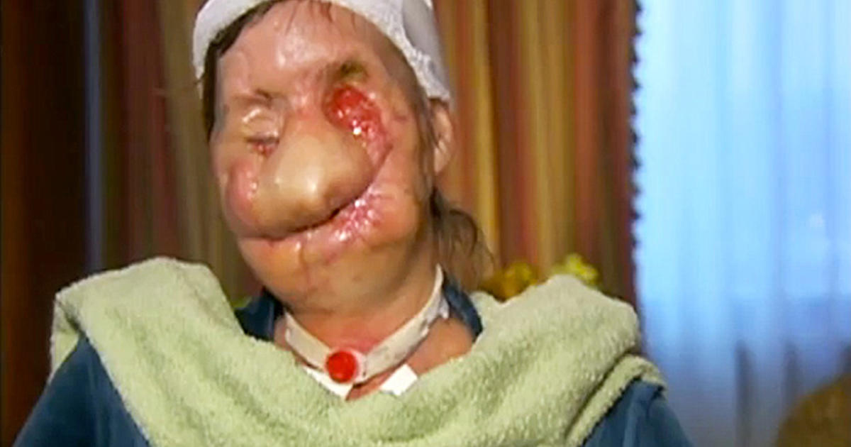 Following face transplant, chimp attack victim Charla Nash talks burgers - CBS News