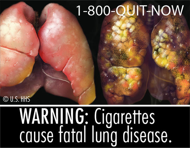 Cigarettes cause fatal lung disease 