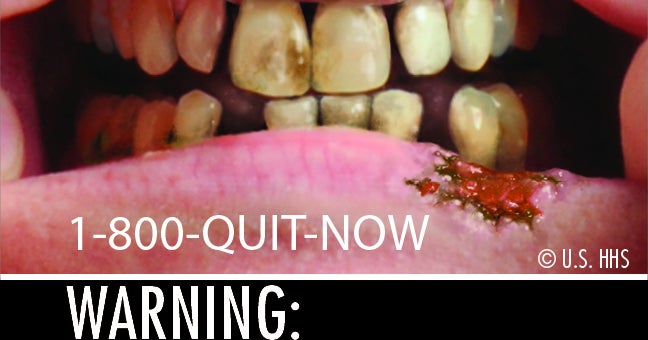 cigarette packet teeth Cigarette warning labels praised, attacked for graphic images (PICTURES)