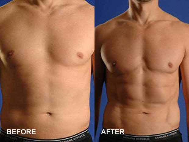 plastic surgery, six pack, cosmetic surgery, abs 