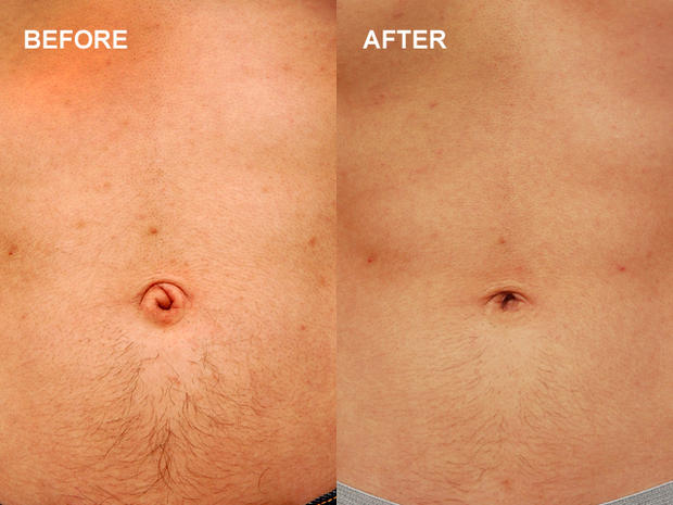 belly button, plastic surgery, cosmetic surgery 