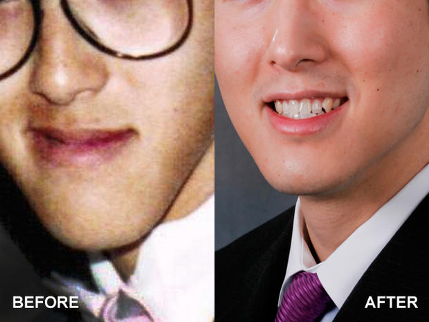 jaw surgery, plastic surgery, cosmetic surgery 