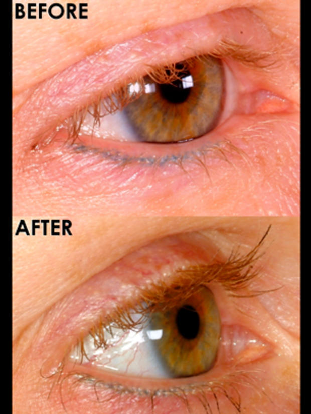 eyelashtransplant.jpg 