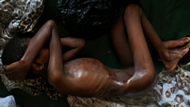 Starvation crisis in Somalia 