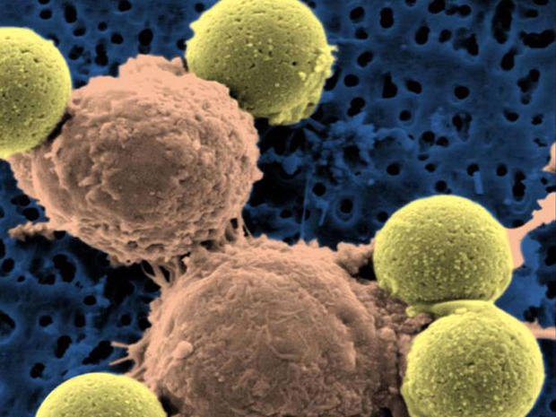 leukemia, gene therapy, carl june, assasin cells, t-cells 