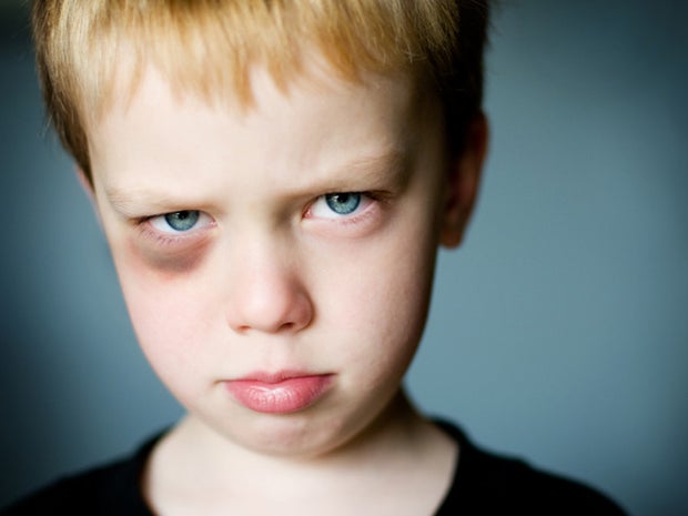 Little boy with a black eye. 