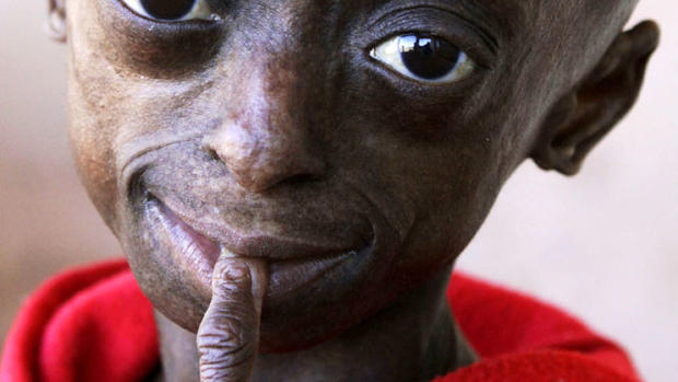 Progeria: First black child with rare aging disease 