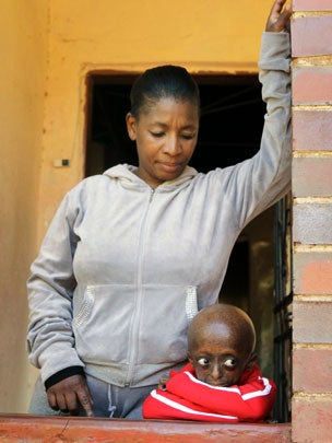 Progeria First black child with rare aging disease