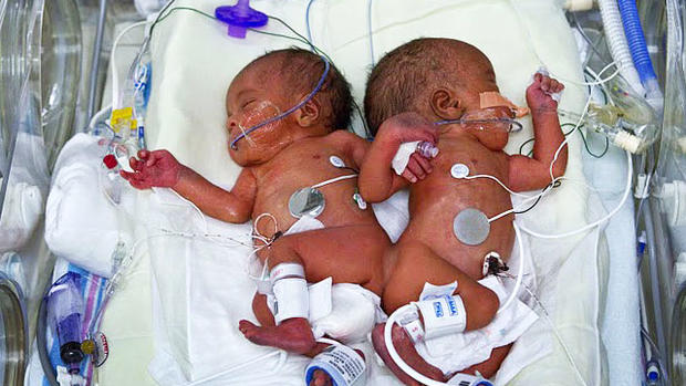 Medical miracle? Conjoined twins separated in Memphis 
