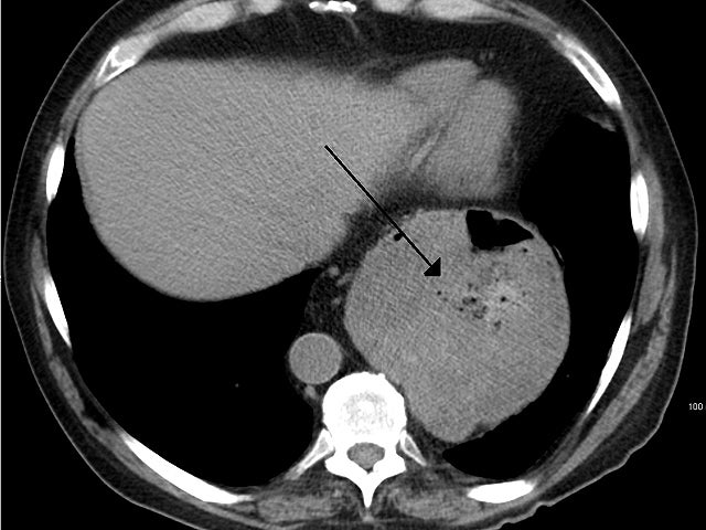 hiatal hernia 