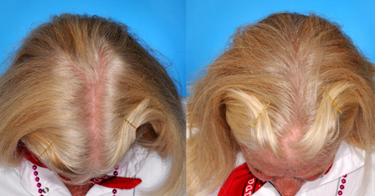 Eek! Hair loss in women: Top 7 risk factors revealed