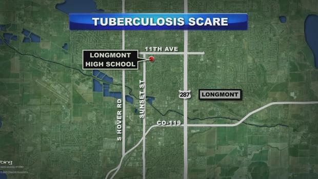Tuberculosis Scare 
