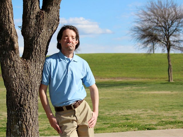 dallas wiens, face transplant