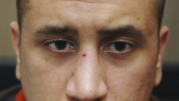 George Zimmerman's injuries 
